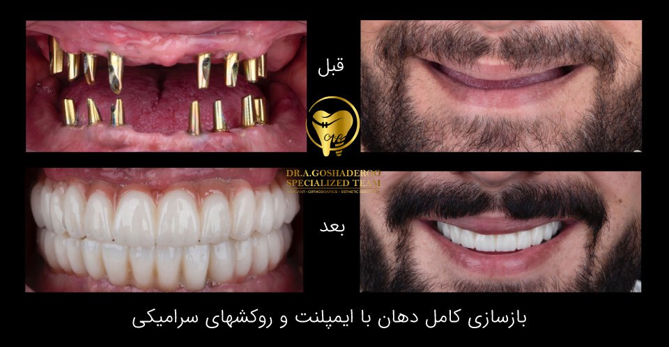 انواع روش‌های ایمپلنت دندان